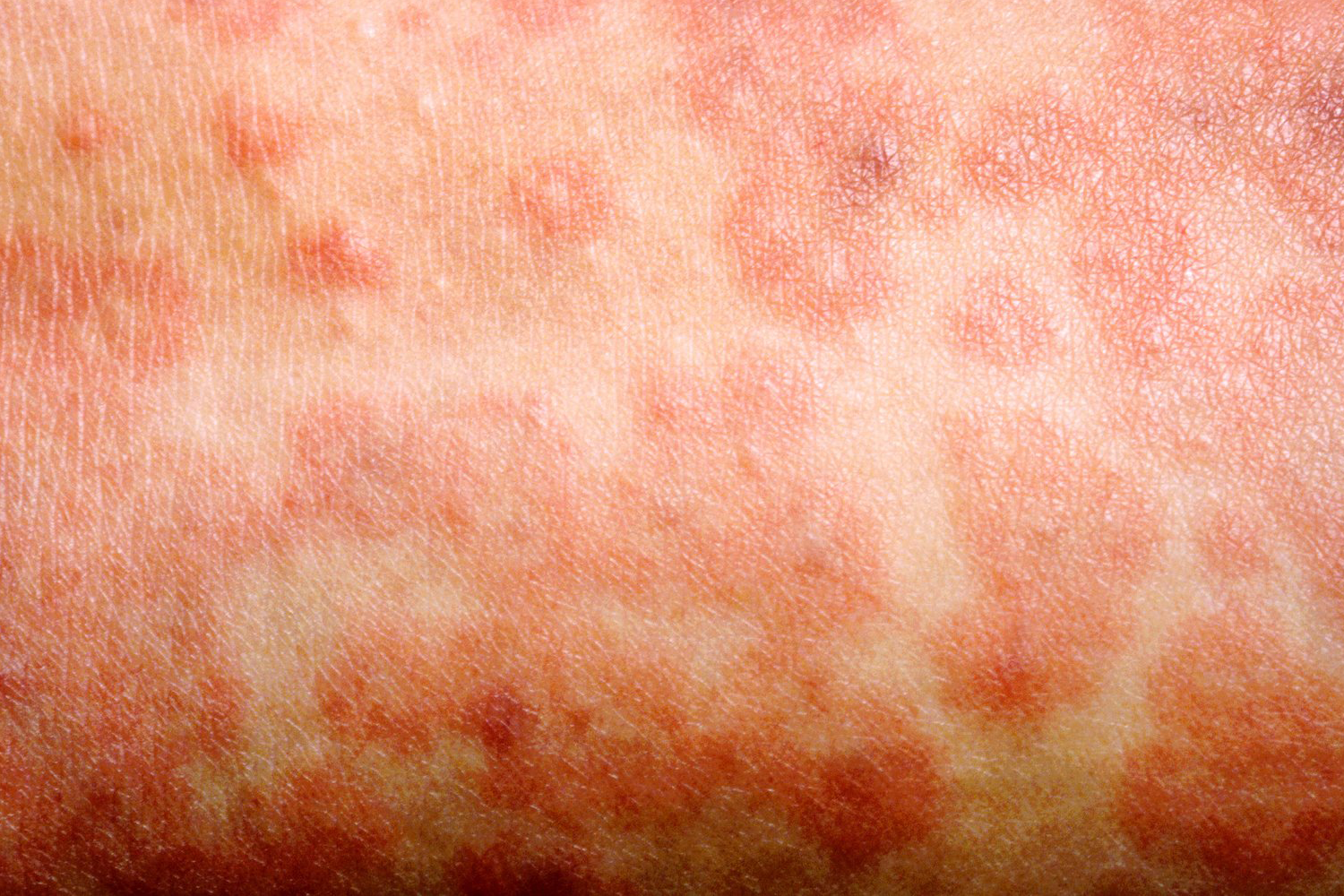 Measles Rash