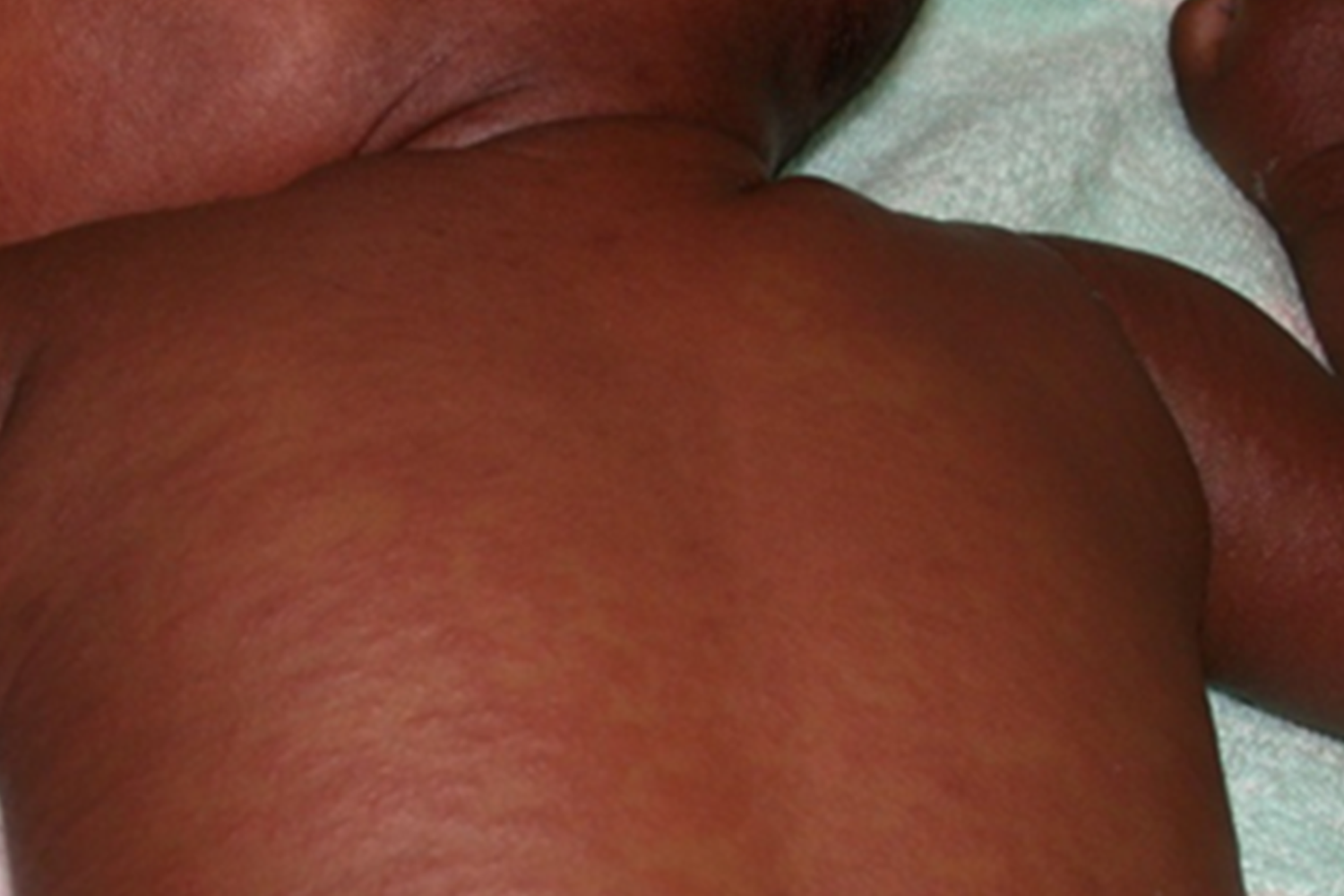 example of rash on brown or black skin