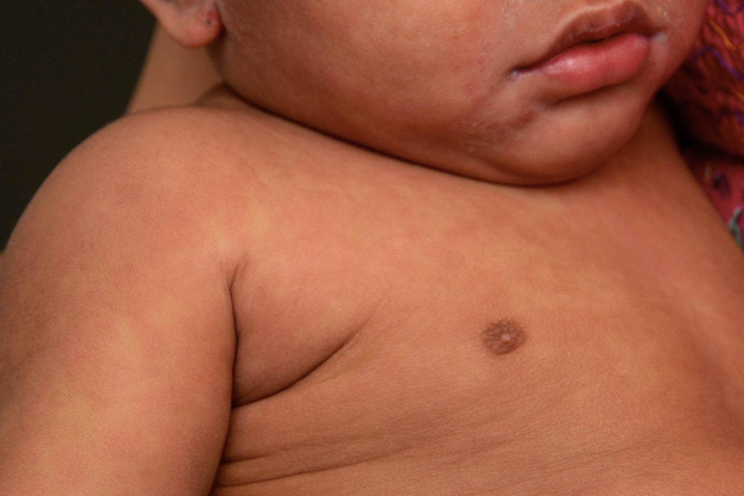 example of rash on brown or black skin