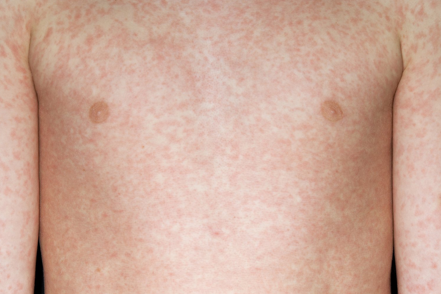 Measles spots on a child's chest