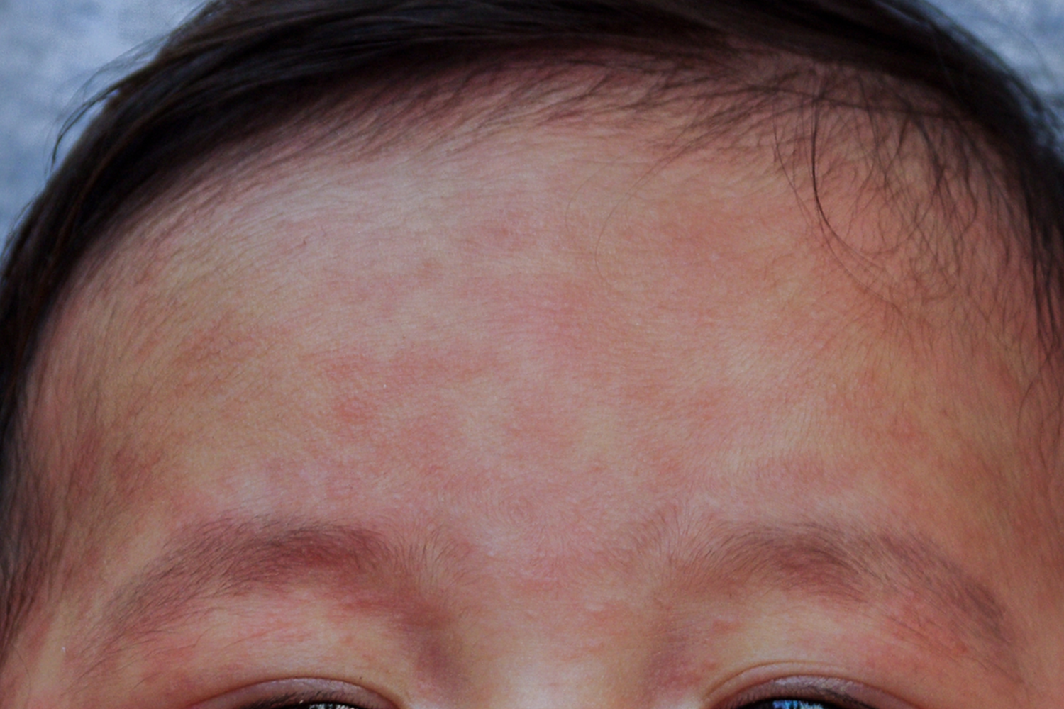 Measles spots on a child's forehead