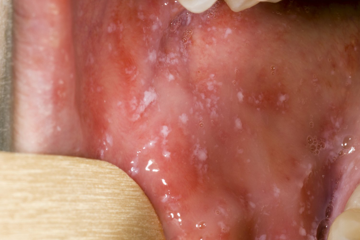 Measles rash white spots under a persons tongue