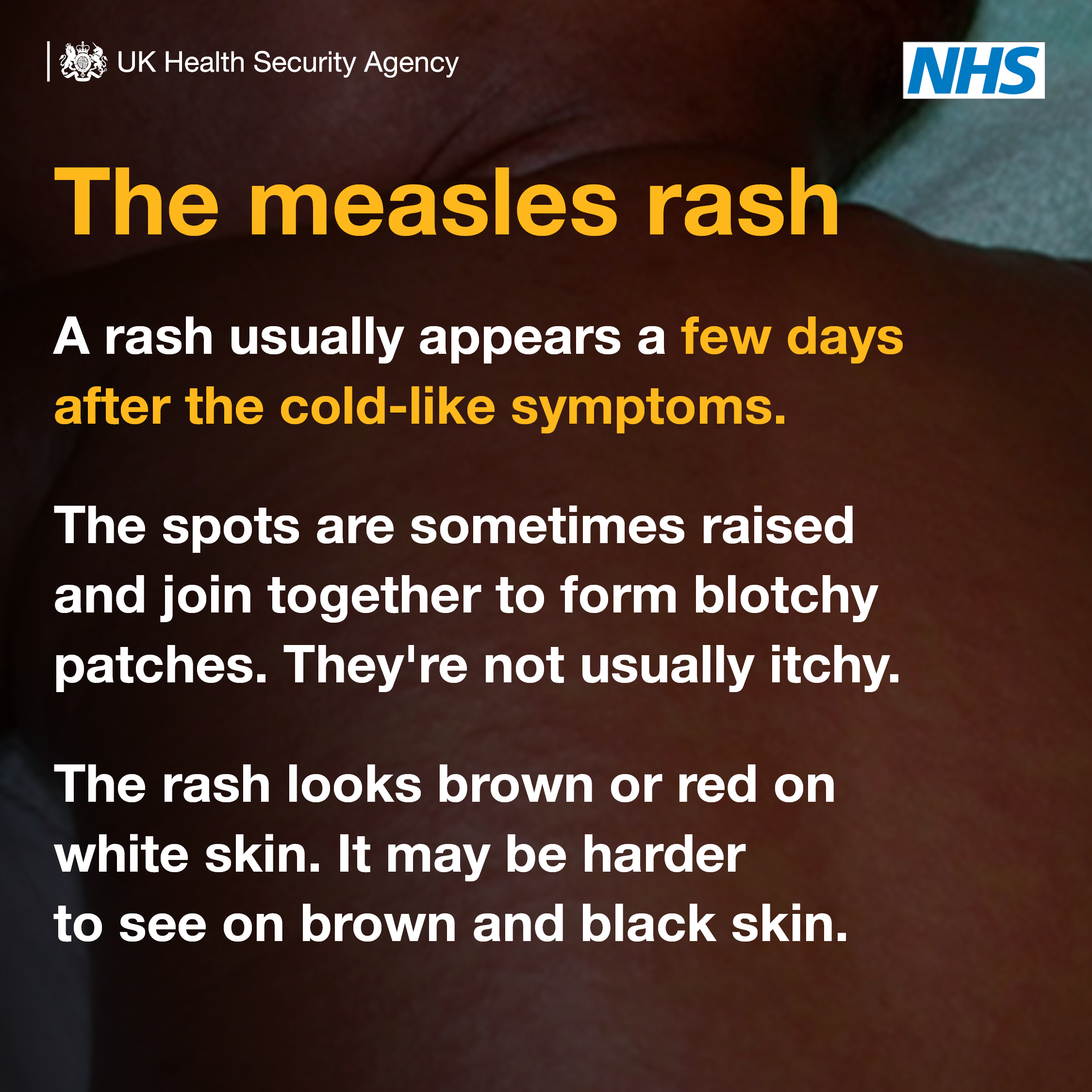 Measles symptoms 2 banner